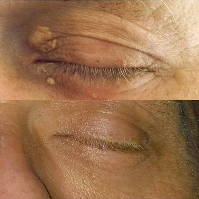 Xanthel results