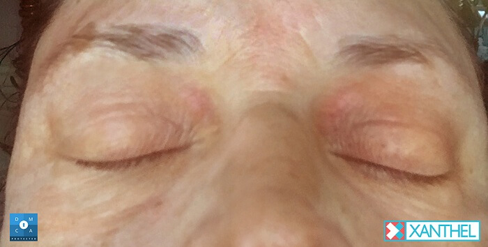 Xanthel Day 8 1