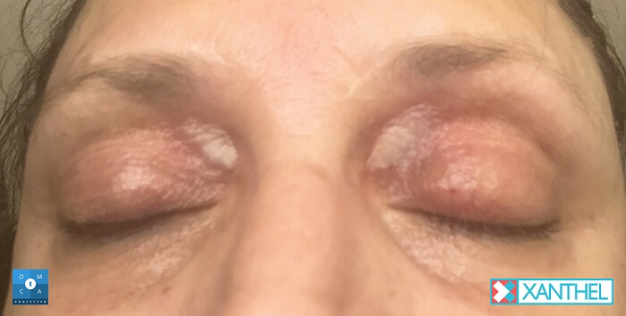 Xanthel day 1 1