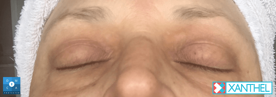 Xanthel day 11
