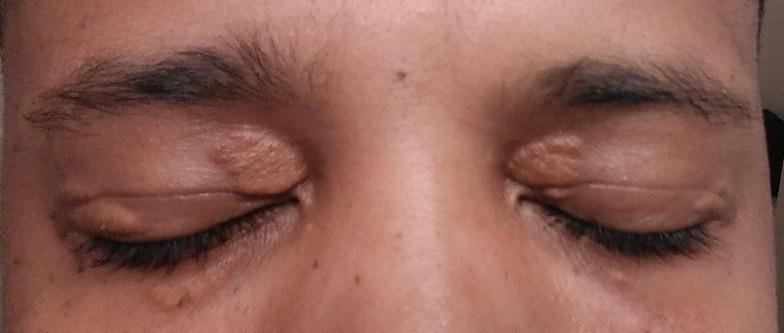 What is xanthelasma: yellow cholesterol deposits around the eyes