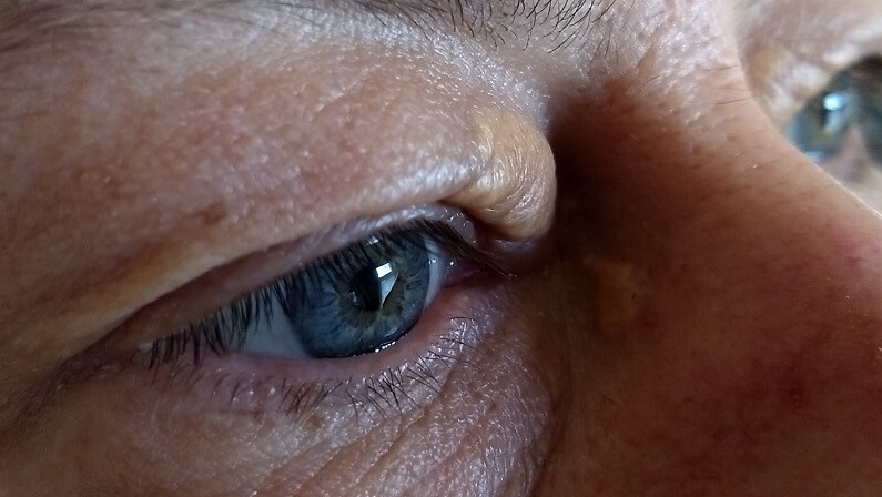 Bilateral xanthelasma: yellow patches on both eyelids