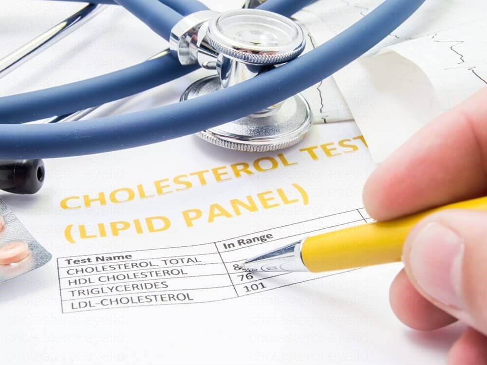 High cholesterol eyes: yellow cholesterol deposits on the eyelid