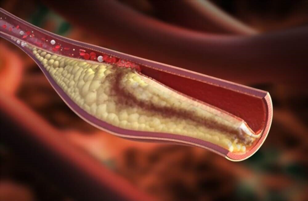 High cholesterol eye bumps on the eyelid