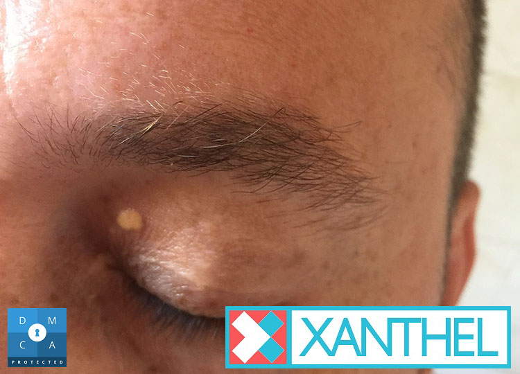 Picture of xanthelasma on the eyelid