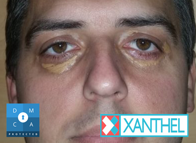 Pictures of cholesterol deposits on the eyelids