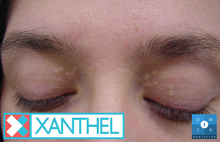Pictures of cholesterol deposits around the eyes