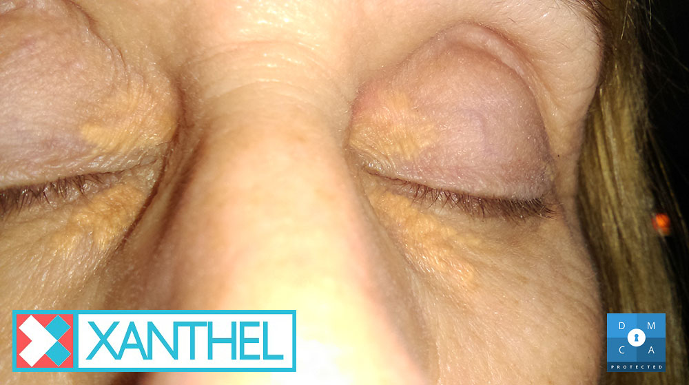 Planar xanthelasma pictures of a flat yellow patch