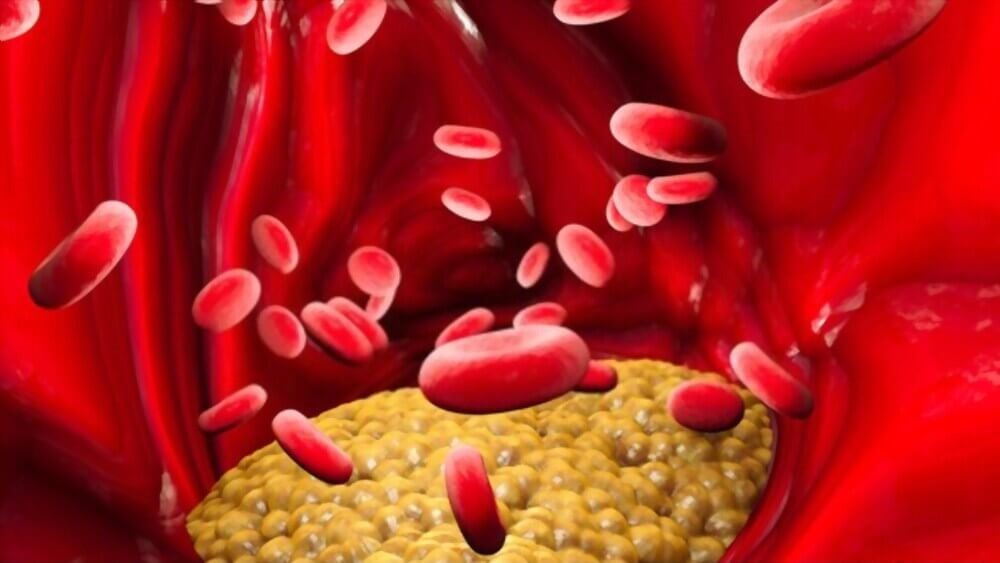 how Cholesterol deposits on the eyelids are possibly formed