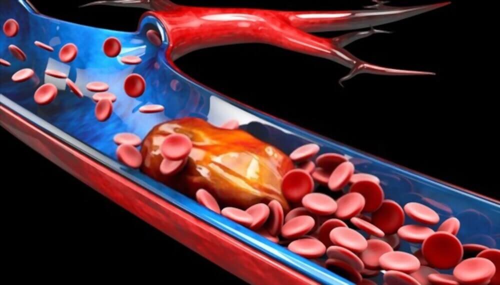 what causes cholesterol eyelids