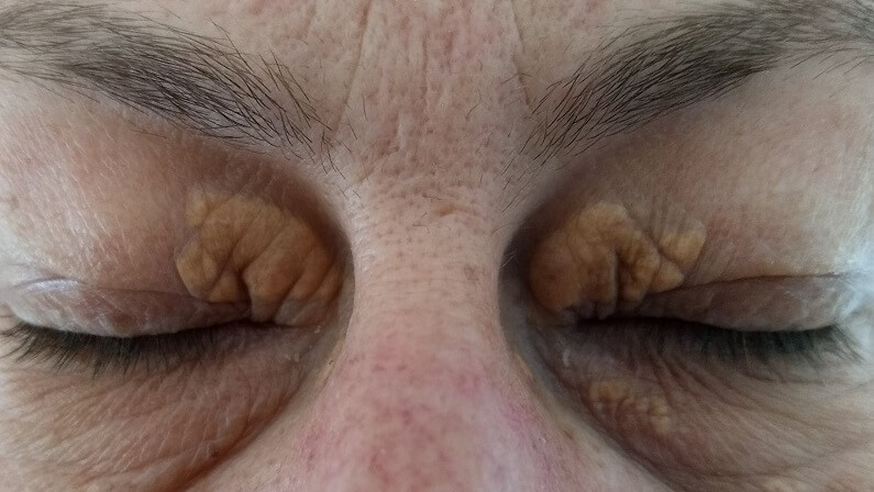 what is xanthelasma 3