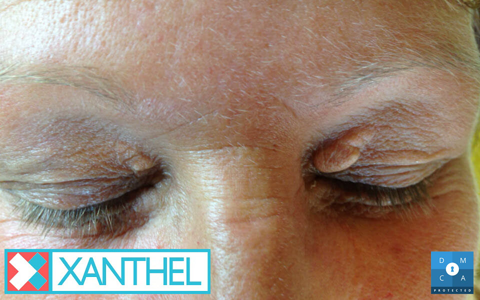 Xanthelasma and xanthoma photos of the eyelids
