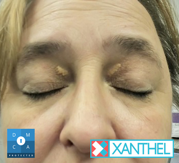 Xanthelasma and xanthomas images