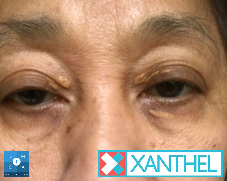 Xanthelasma and xanthomas pictures compared