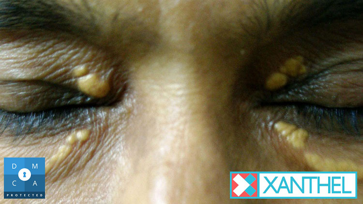 Xanthelasma and xanthomatosis pictures