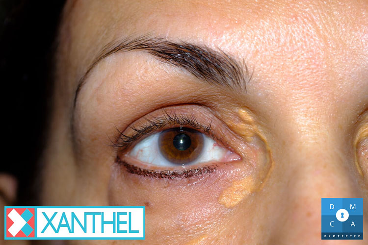 Xanthelasma image of yellow patches near the eye