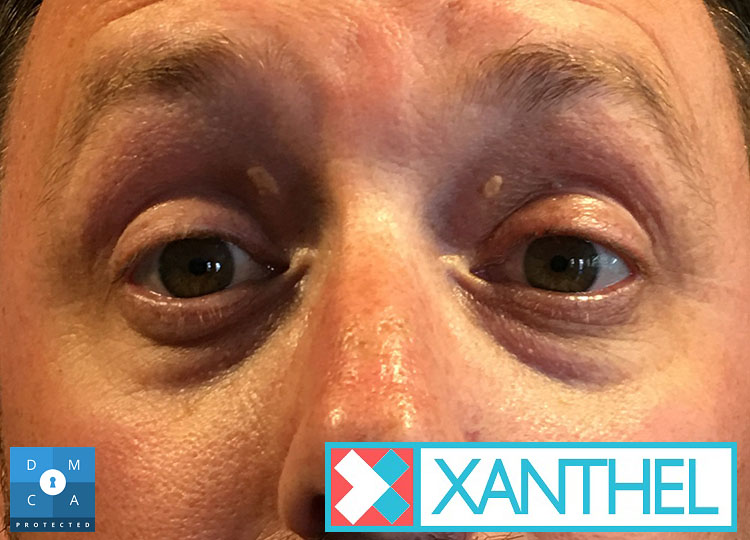 Xanthelasma of the eyelid images