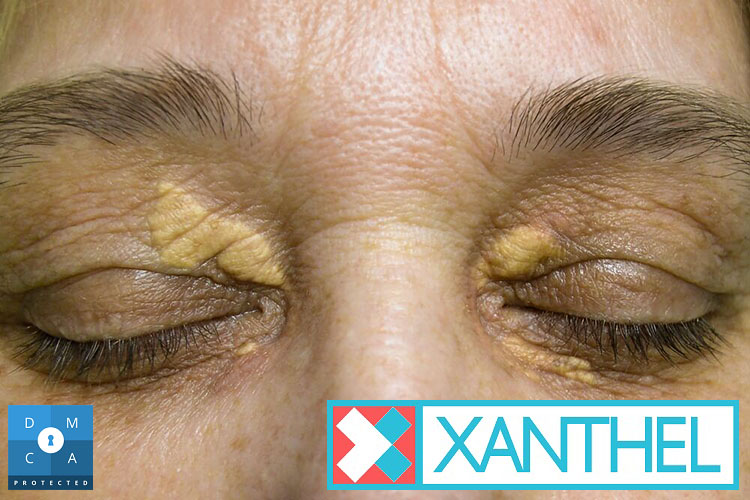Cholesterol deposit pictures on the eyelid