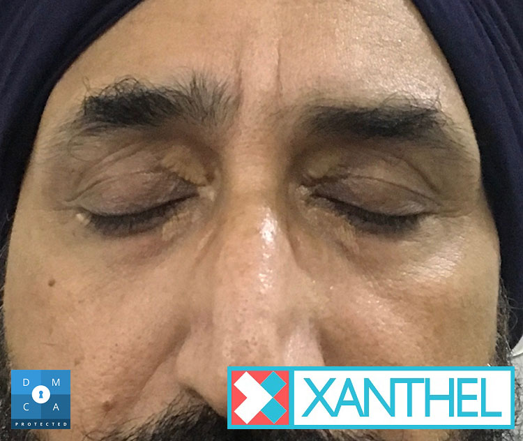 Images of xanthelasma showing the colour and shape of eyelid patches