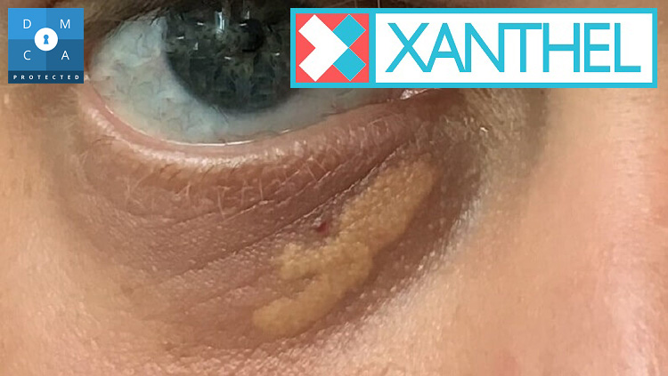 Pictures of xanthelasma of the eyelid