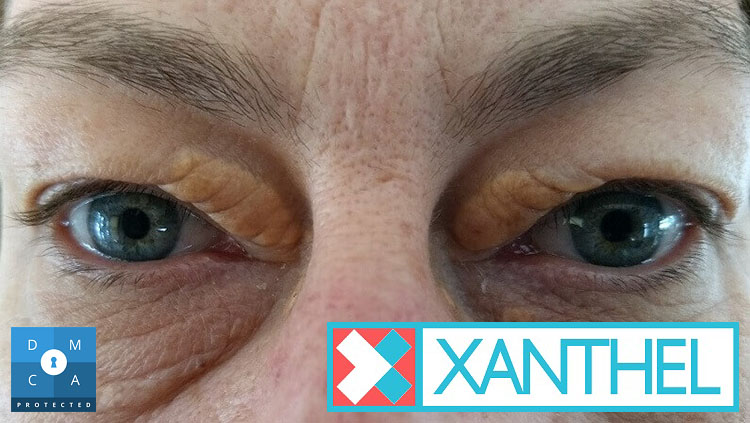 Xanthomatous deposits on the eyelids