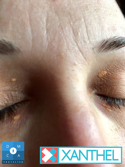 More xanthoma images of eyelid patches