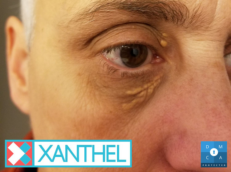 Xanthoma eye pictures of a yellow eyelid patch