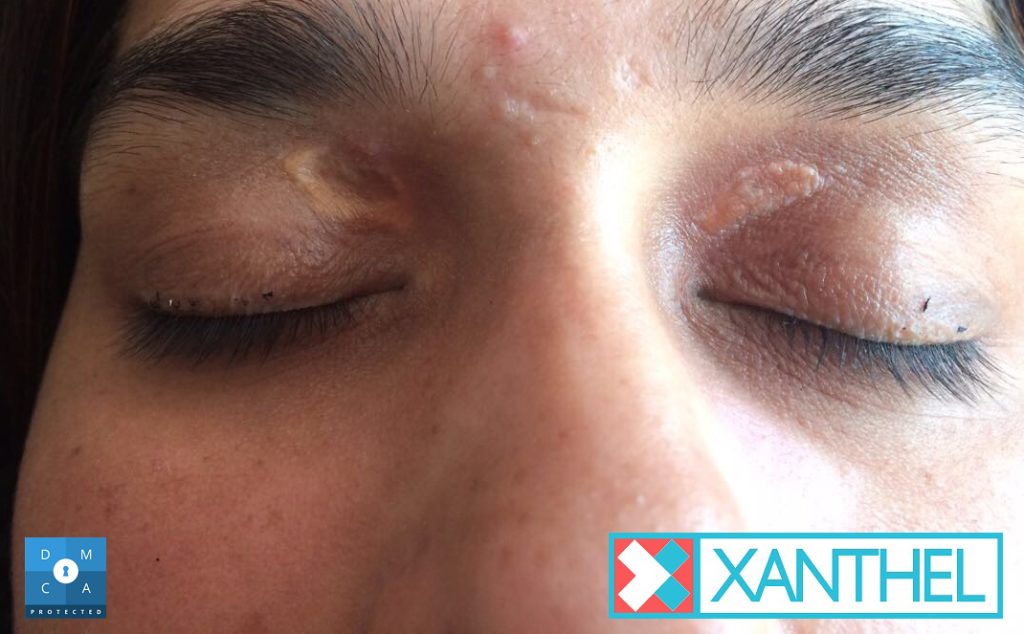 Xanthoma pictures of the eye area