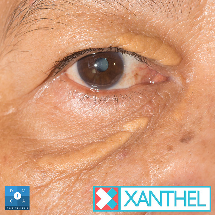Xanthoma pictures on the skin