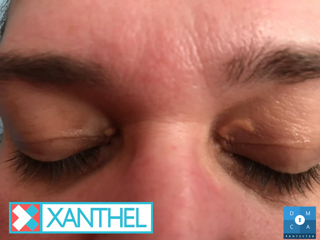 Xanthoma pictures of a fatty yellow deposit under the skin