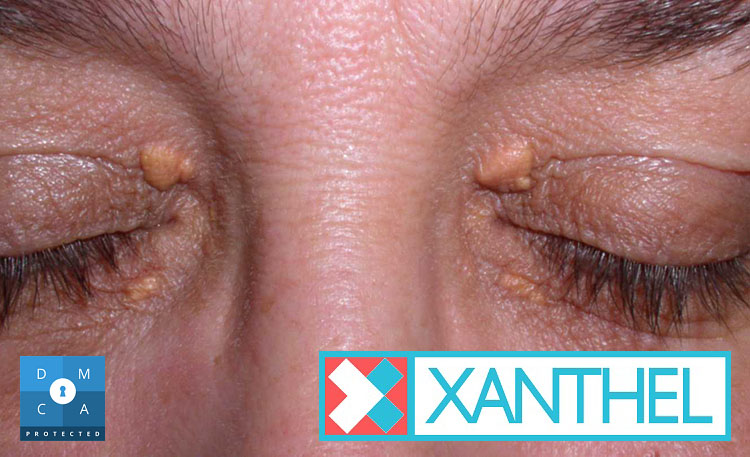 Images of xanthomas by the eye