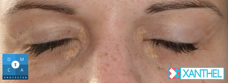 Xanthomas images of soft yellow patches near the eye