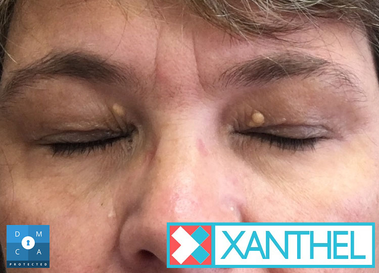 Xanthomas pictures on the eyelids