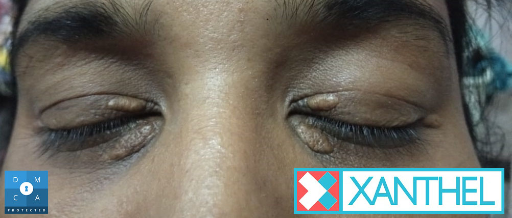 Xanthomas pictures: pale yellow deposits on the eyelid skin