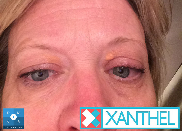 Xanthomas under the eye on the lower eyelid