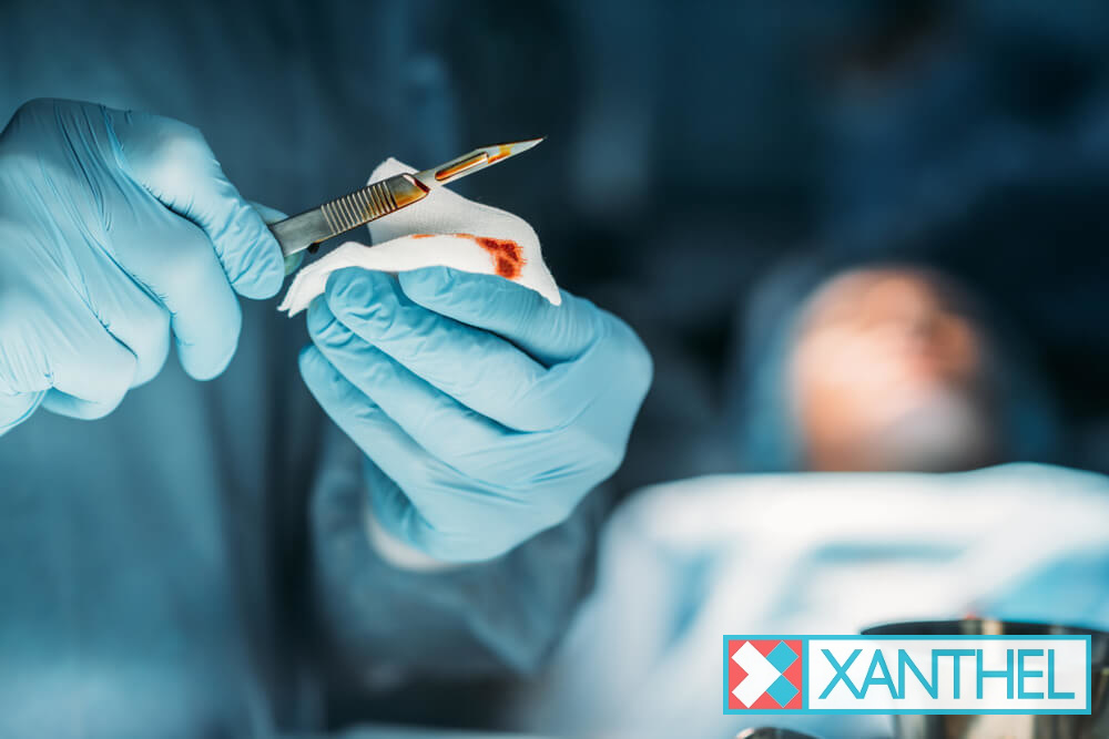 Surgical removal of xanthelasma