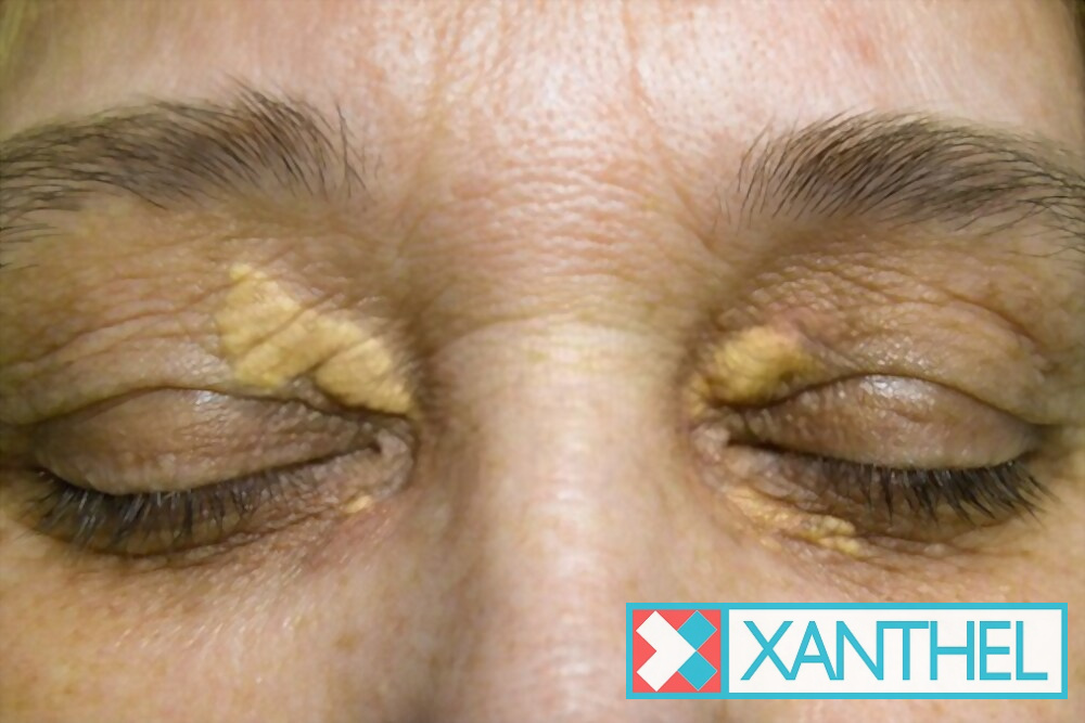 Xanthelasma palpebrarum: cholesterol deposits on the eyelids