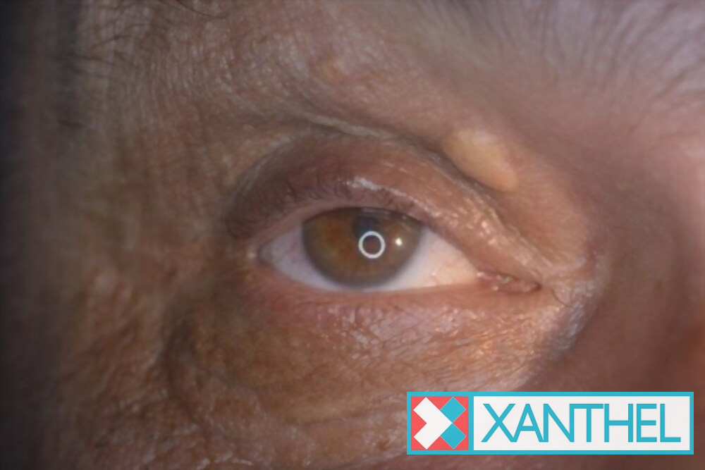 Yellow xanthelasma patch beside the eye