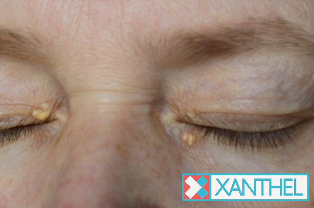 Cholesterol spots on the eyelid
