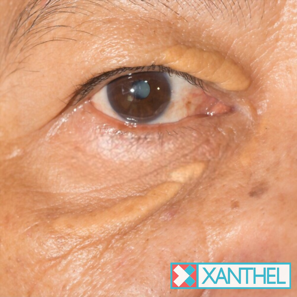 Xanthelasma photo: a large yellow patch on the eyelid