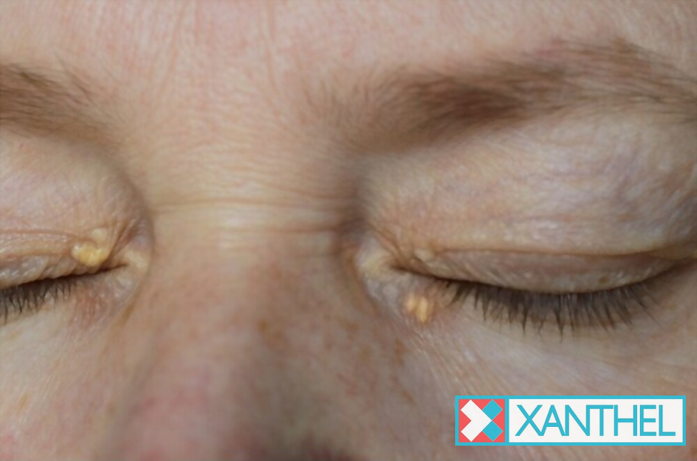 Xanthelasma pictures of the eyelids: a mild patch
