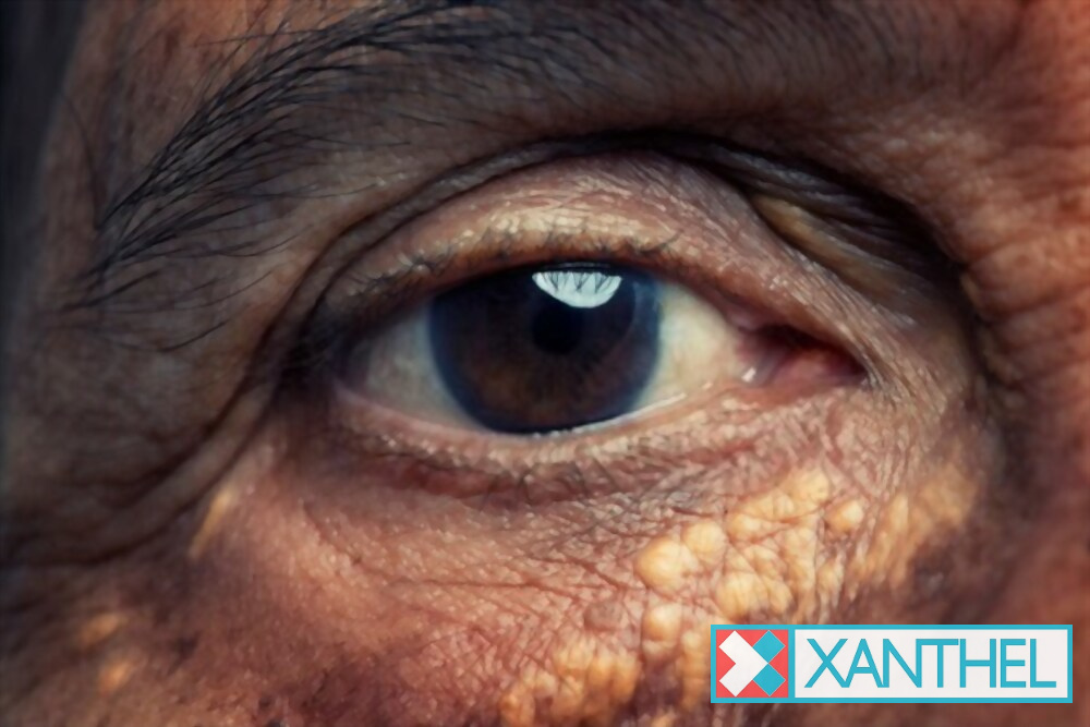 Xanthelasma pictures: yellow patches on the eyelid skin
