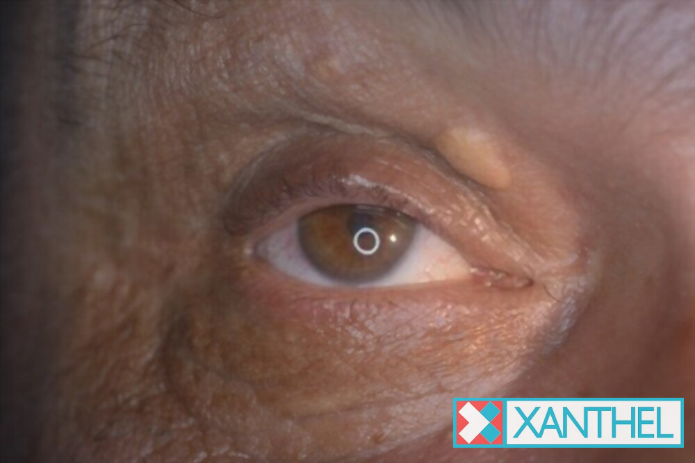 Xanthelasma photo: a yellow patch on the eyelid