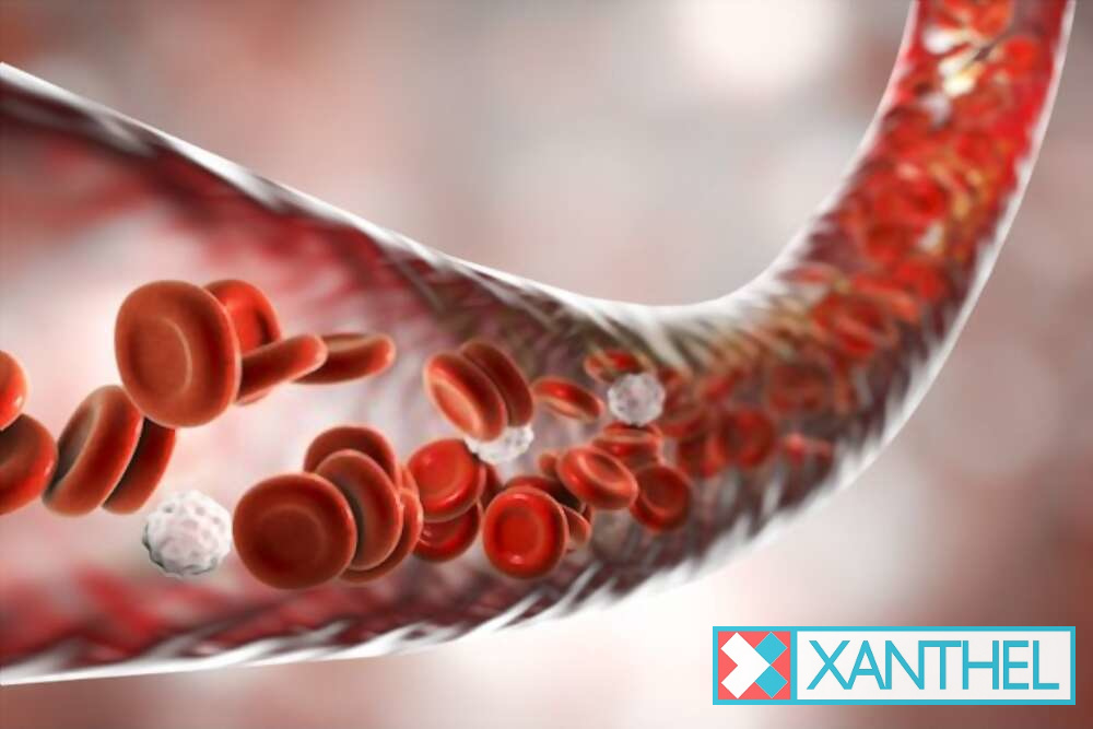 Xanthoma under the eye: an example of xanthelasma
