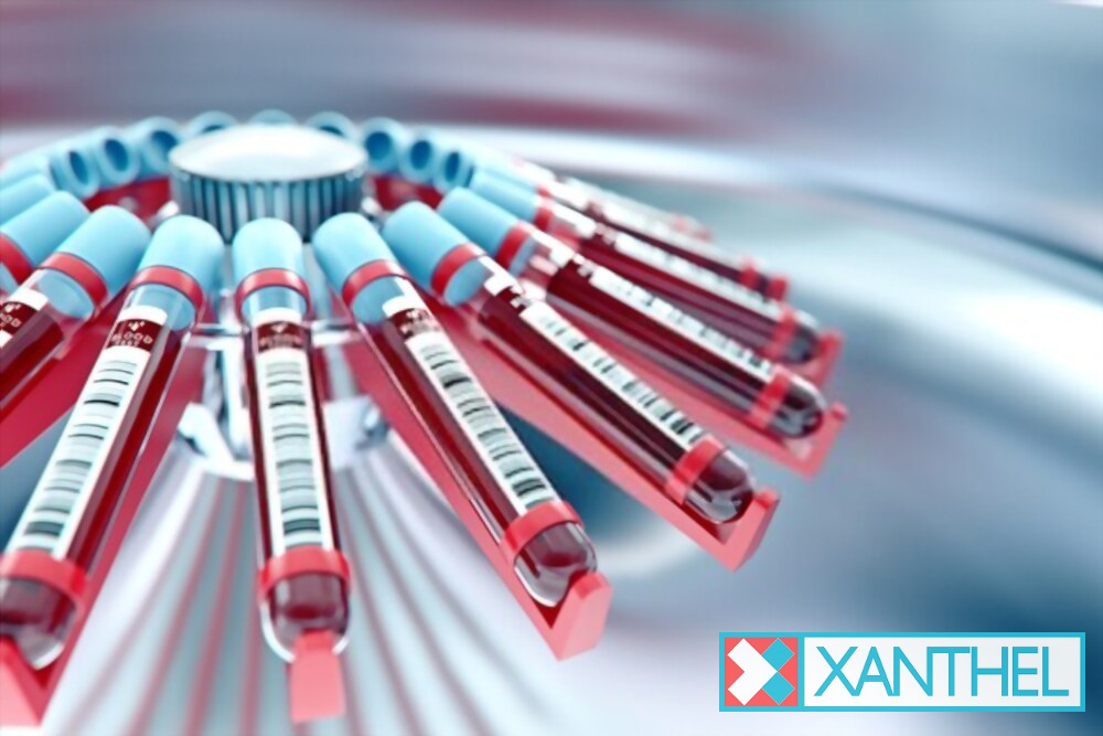 Cholesterol bumps under eyes: an example of xanthelasma