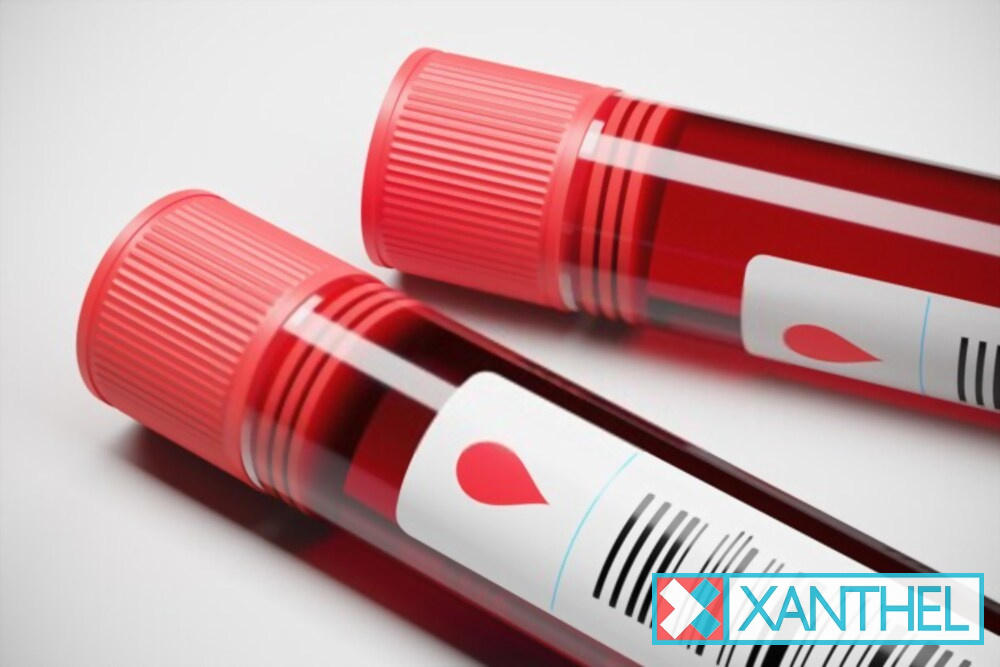 Xanthelasma under eyes: an example photo