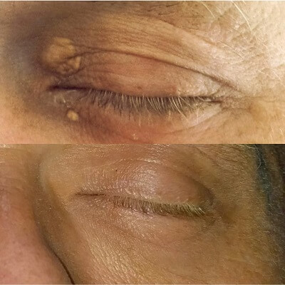 Xanthelasma treatment cream: a Xanthel® customer result