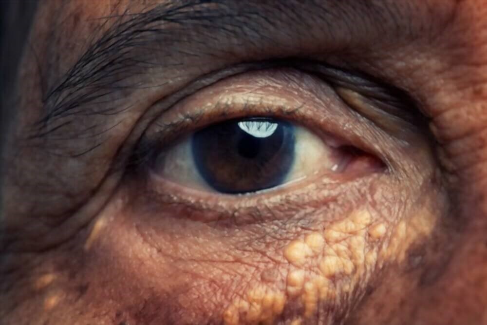 Xanthelasma surgical removal: cholesterol deposits on the eyelid