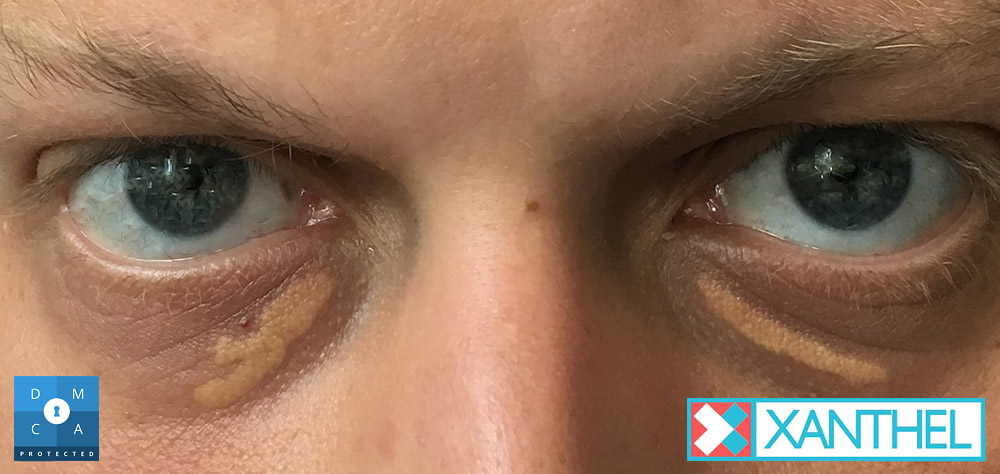 Cholesterol deposits on eyelids treatment