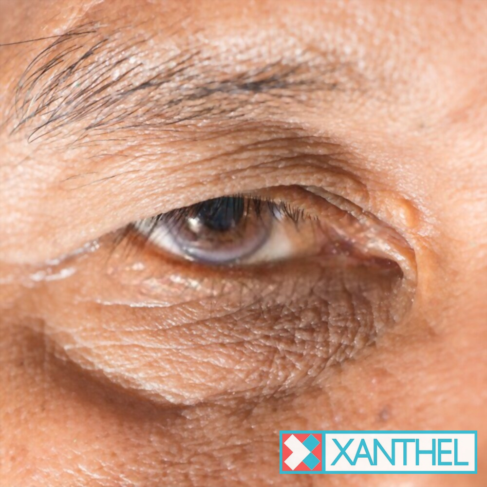 Xanthelasma laser removal: a small patch near the eye